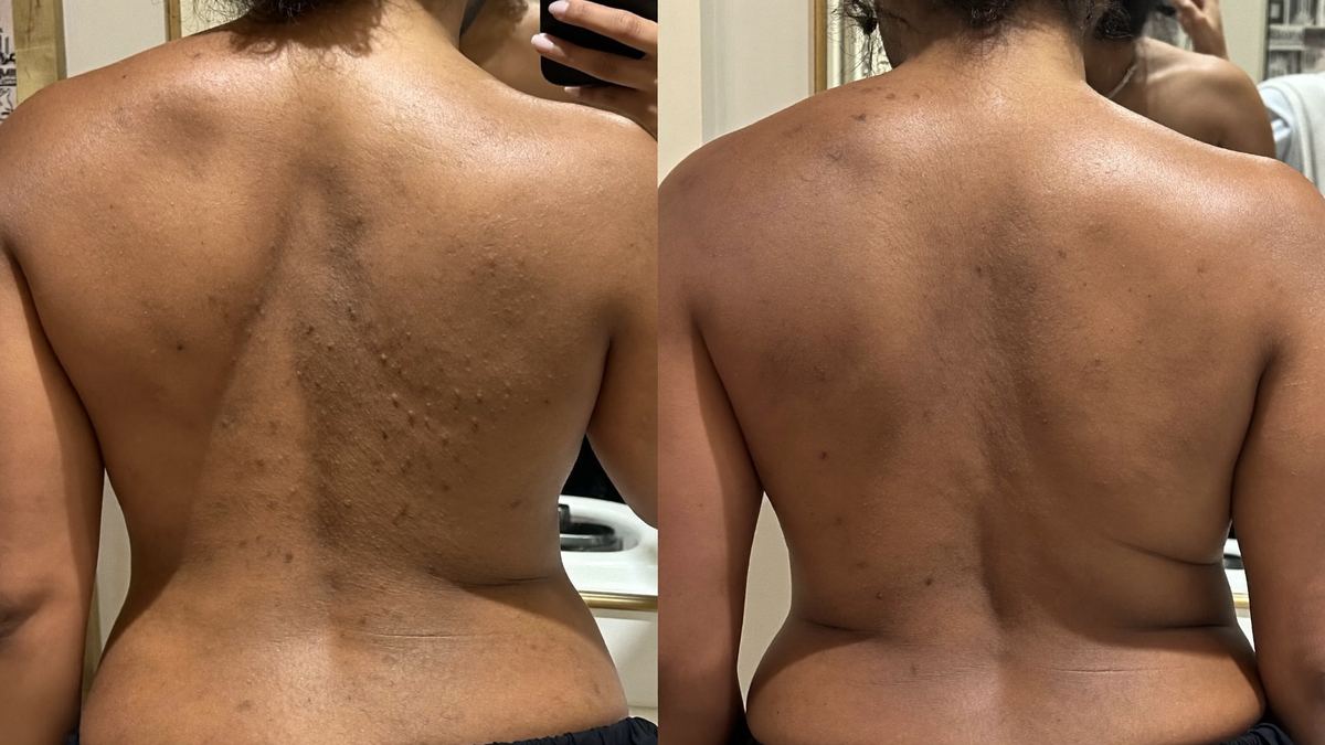 Before and after of back skin texture, mirror photos